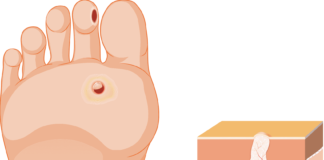 Ayak Siğili Nedir? Tedavisi Nasıl Yapılır?